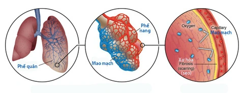 Hình ảnh các xơ trong phổi