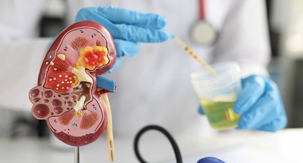 Xét nghiệm nước tiểu là phương pháp phổ biến để chẩn đoán thận hư