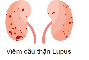 Bệnh thận Lupus là một loại bệnh tự miễn