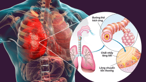Hình ảnh phổi ở người mắc bệnh phổi tắc nghẽn mạn tính