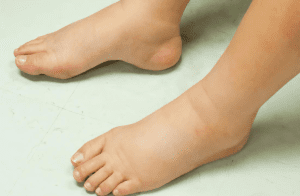 Phù nề là một trong những biểu hiện của bệnh thận IgA