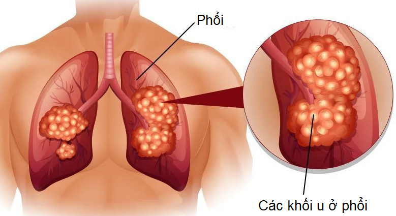 Ung thư phổi là hiện tượng các tế bào tại phổi phát triển bất thường